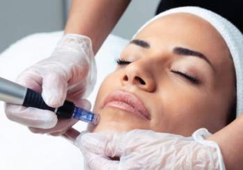 Tratamiento Especial (tiempo limitado): 2 sesiones de Dermapen + Exosomas en Madrid